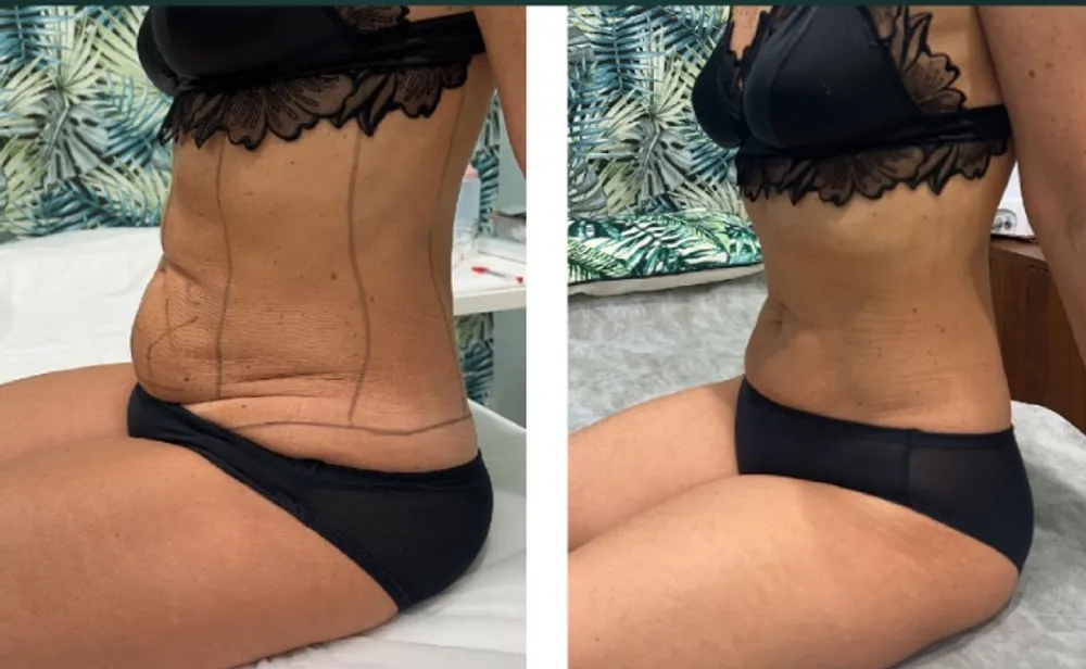 Antes e depois — cintura e abdómen
