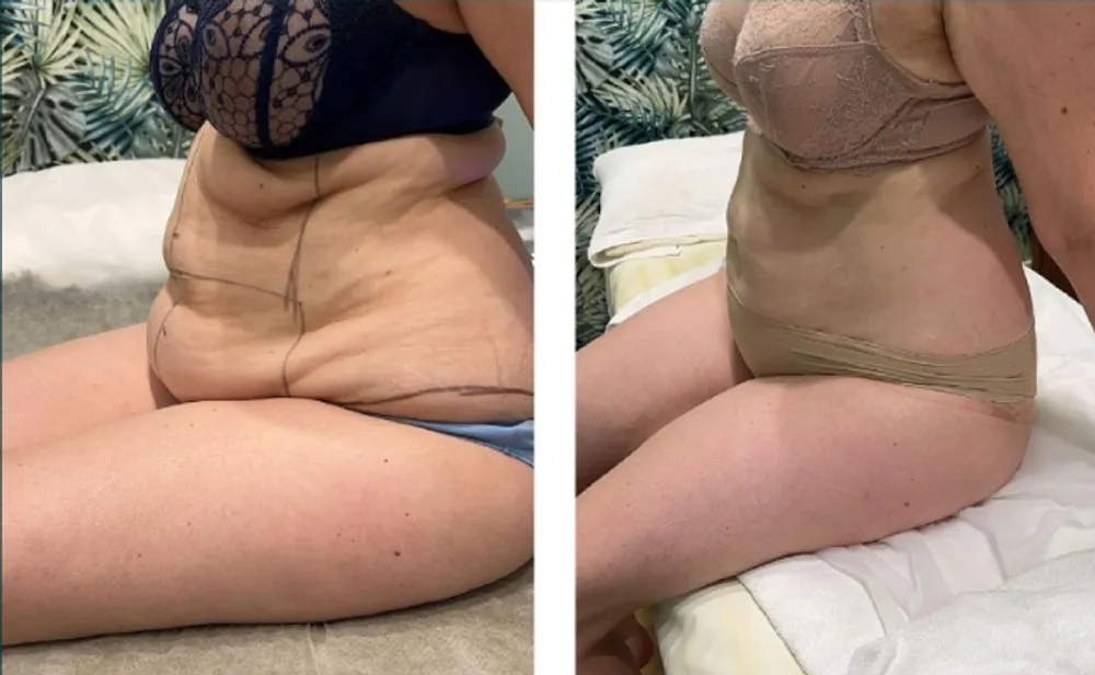 Antes e depois — abdómen inferior